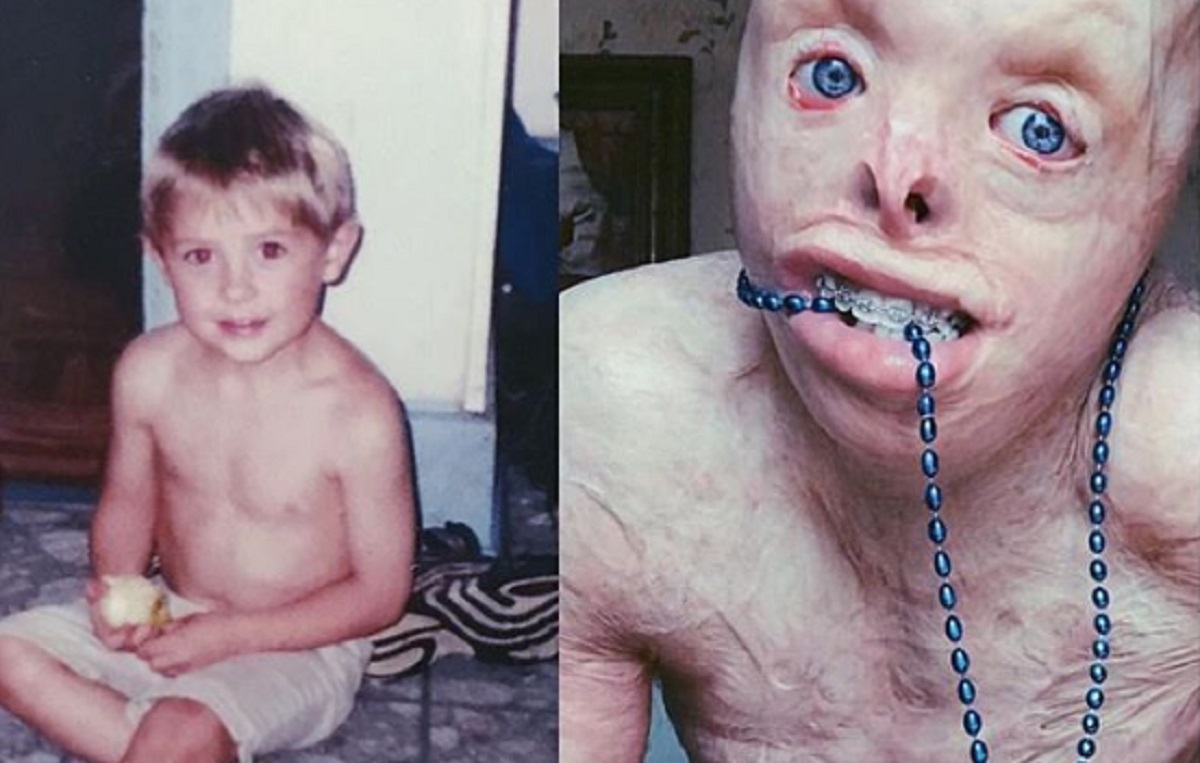 Un adolescent est d�figur� par la feu et pense �tre un monstre, mais un camp change sa vie