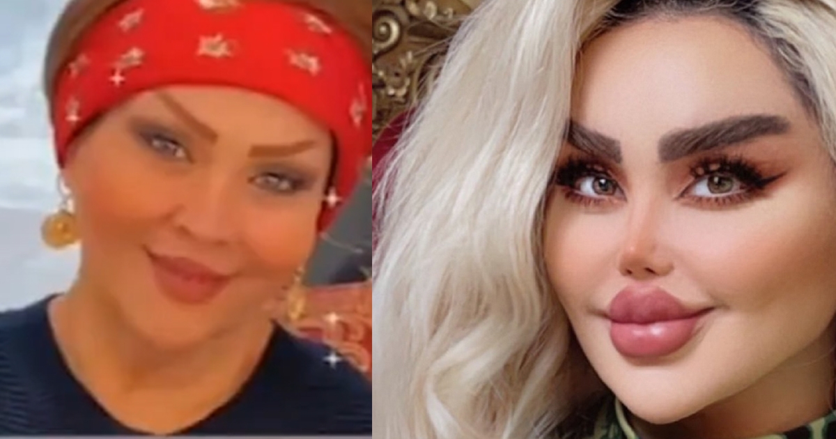 Une femme voulant ressembler  Barbie est compltement mconnaissable aprs ses 43 chirurgies